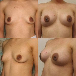 breastaugmentation1736